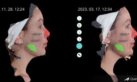 Megérkezett Magyarországra 2023 leginnovatívabb arckezelése EMFACE®: arcplasztika műtét nélkül