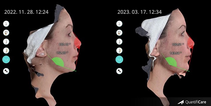 Megérkezett Magyarországra 2023 leginnovatívabb arckezelése EMFACE®: arcplasztika műtét nélkül